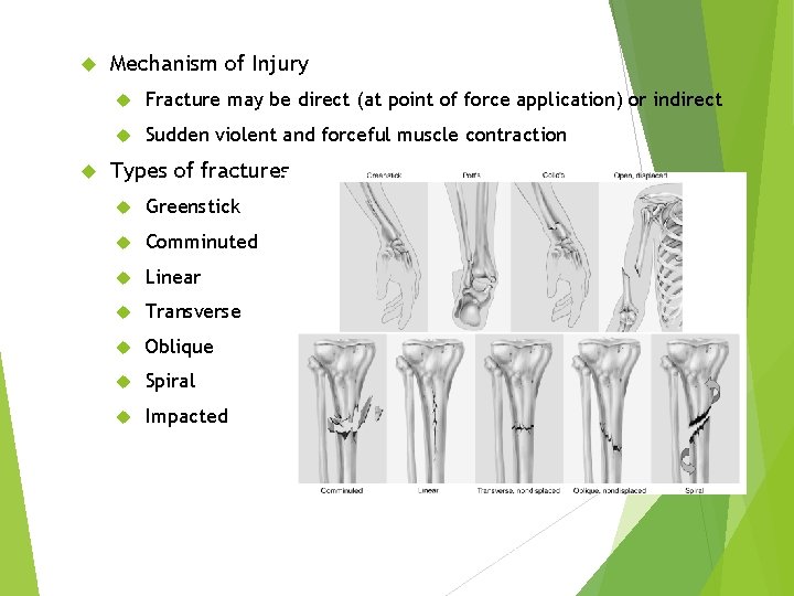  Mechanism of Injury Fracture may be direct (at point of force application) or