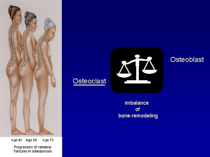 Osteoblast Osteoclast imbalance of bone-remodeling Age 40 Age 60 Age 70 Progression of vertebral