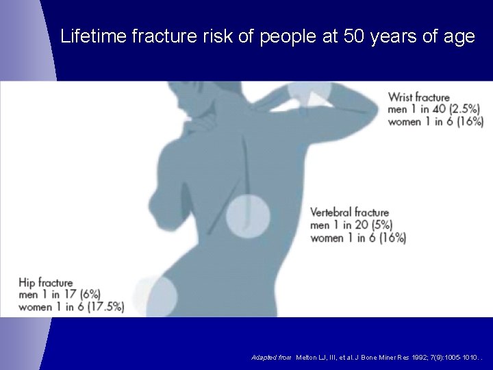 Lifetime fracture risk of people at 50 years of age Adapted from Melton LJ,