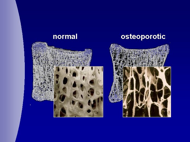 normal osteoporotic 