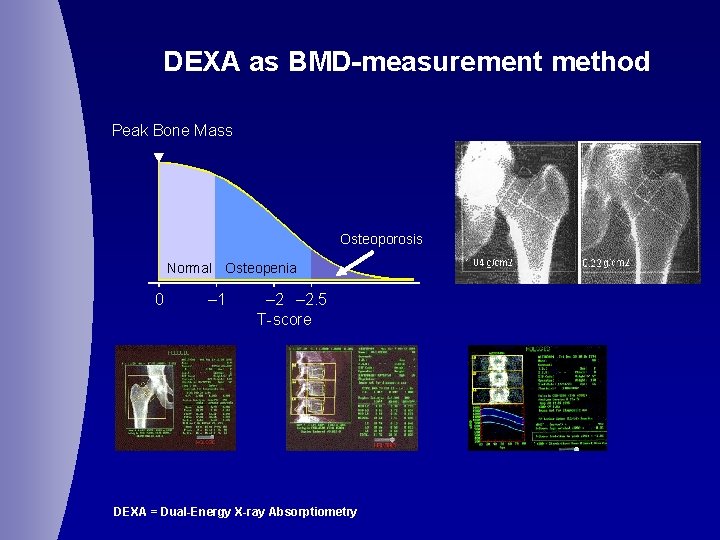 DEXA as BMD-measurement method Peak Bone Mass Osteoporosis Normal Osteopenia 0 – 1 –