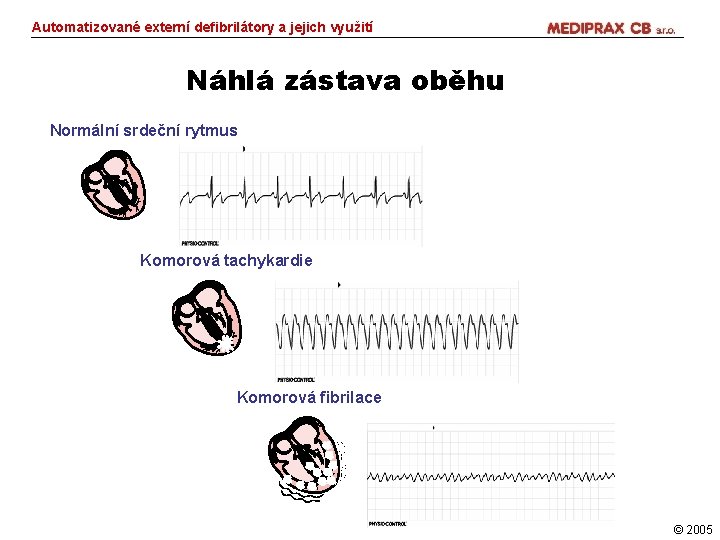 Automatizované externí defibrilátory a jejich využití Náhlá zástava oběhu Normální srdeční rytmus Komorová tachykardie