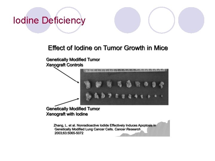 Iodine Deficiency 