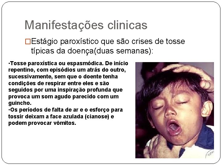 Manifestações clinicas �Estágio paroxístico que são crises de tosse típicas da doença(duas semanas): •