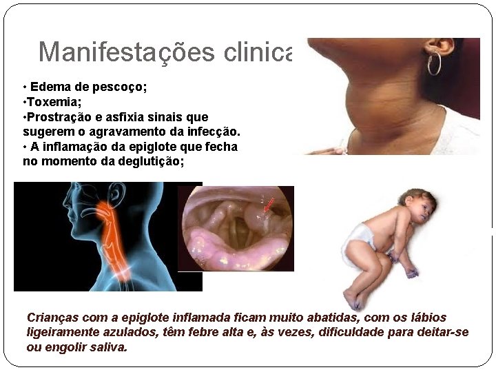 Manifestações clinicas • Edema de pescoço; • Toxemia; • Prostração e asfixia sinais que