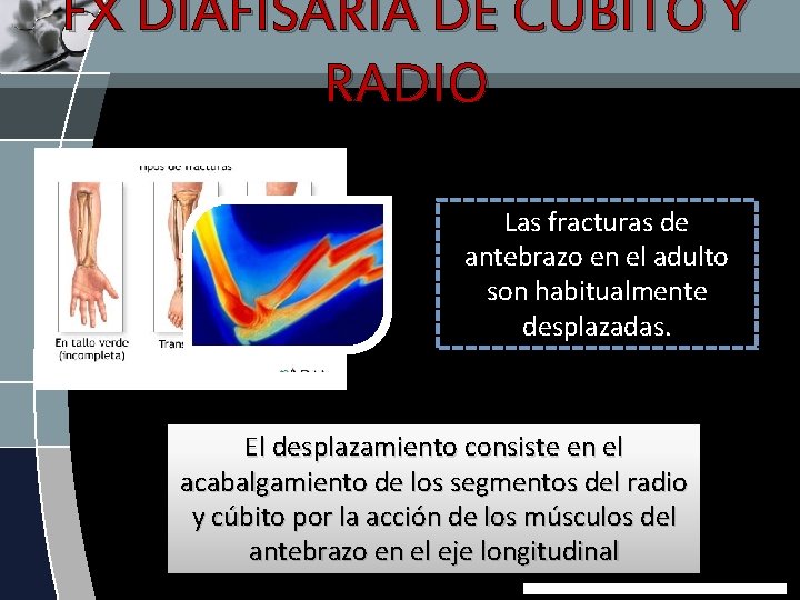 FX DIAFISARIA DE CUBITO Y RADIO Las fracturas de antebrazo en el adulto son