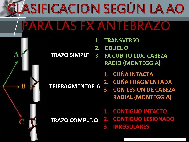 CLASIFICACION SEGÚN LA AO PARA LAS FX ANTEBRAZO 1. TRANSVERSO 2. OBLICUO TRAZO SIMPLE