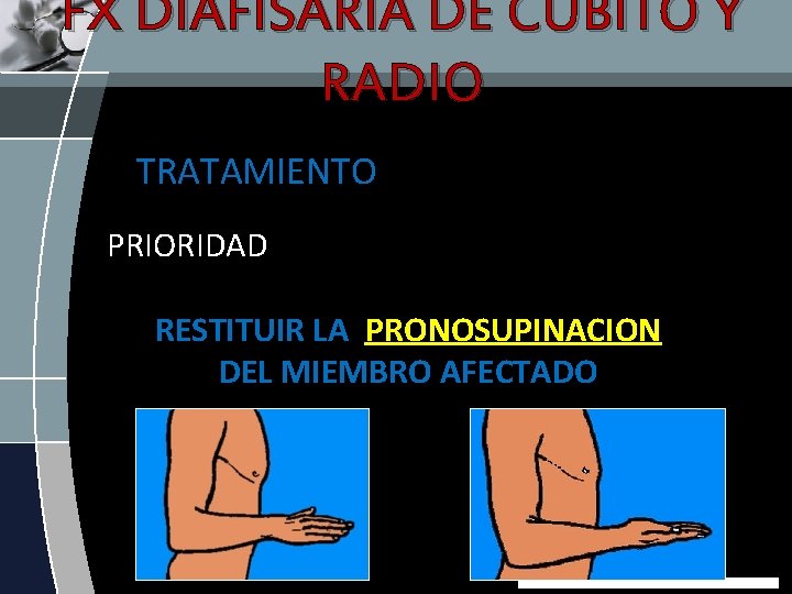 FX DIAFISARIA DE CUBITO Y RADIO TRATAMIENTO PRIORIDAD RESTITUIR LA PRONOSUPINACION DEL MIEMBRO AFECTADO