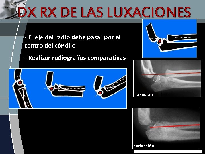 DX RX DE LAS LUXACIONES - El eje del radio debe pasar por el