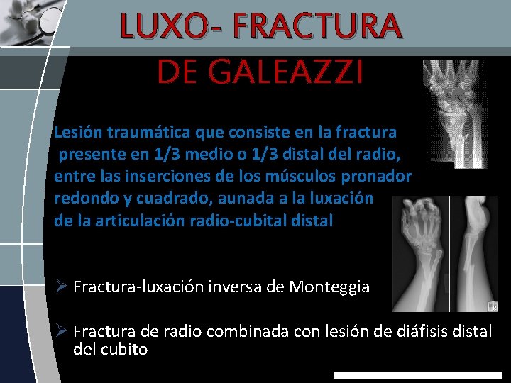 LUXO- FRACTURA DE GALEAZZI Lesión traumática que consiste en la fractura presente en 1/3