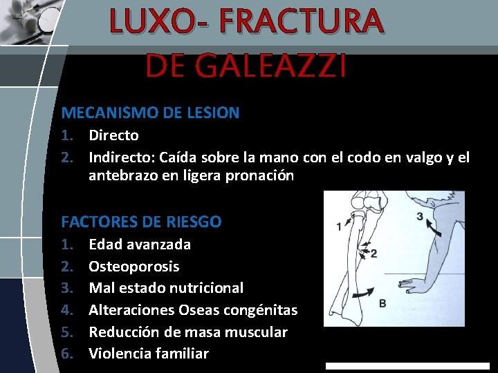 LUXO- FRACTURA DE GALEAZZI MECANISMO DE LESION 1. Directo 2. Indirecto: Caída sobre la