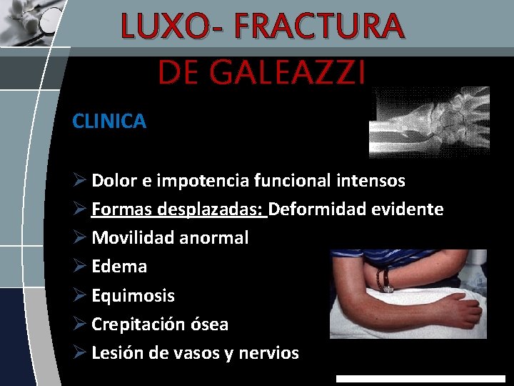 LUXO- FRACTURA DE GALEAZZI CLINICA Ø Dolor e impotencia funcional intensos Ø Formas desplazadas: