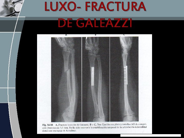 LUXO- FRACTURA DE GALEAZZI 