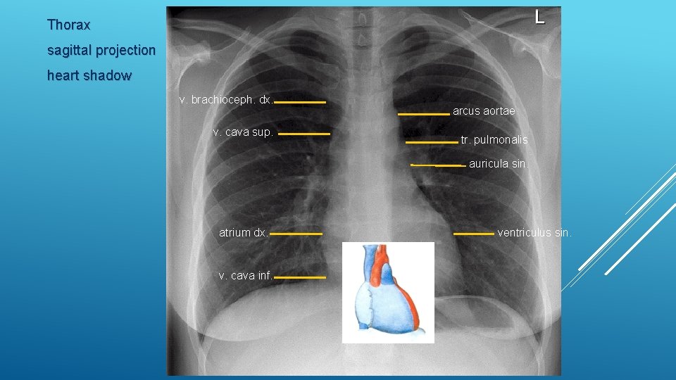 Thorax sagittal projection heart shadow v. brachioceph. dx. v. cava sup. arcus aortae tr.