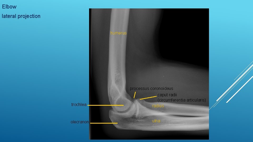 Elbow lateral projection humerus processus coronoideus trochlea caput radii (circumferentia articularis) radius olecranon ulna