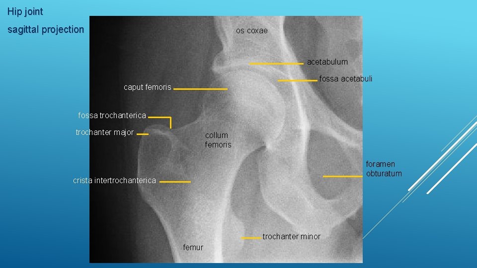 Hip joint sagittal projection os coxae acetabulum fossa acetabuli caput femoris fossa trochanterica trochanter