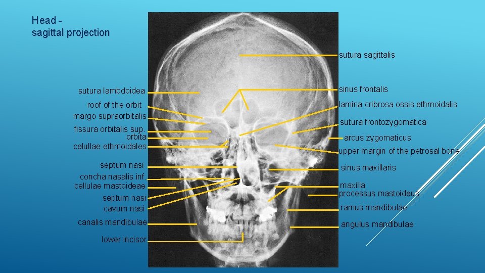 Tage med paraply bevægelse XRAYS WITH DESCRIPTION Head sagittal projection sutura sagittalis