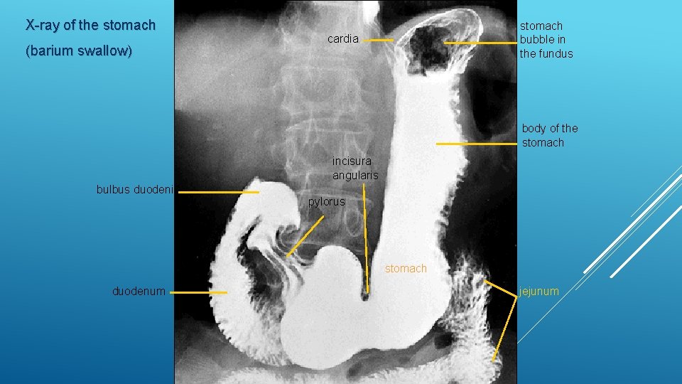 X-ray of the stomach (barium swallow) stomach bubble in the fundus cardia body of