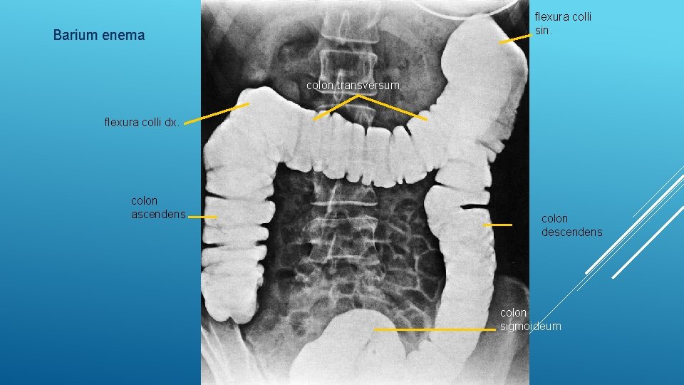 flexura colli sin. Barium enema colon transversum flexura colli dx. colon ascendens colon descendens