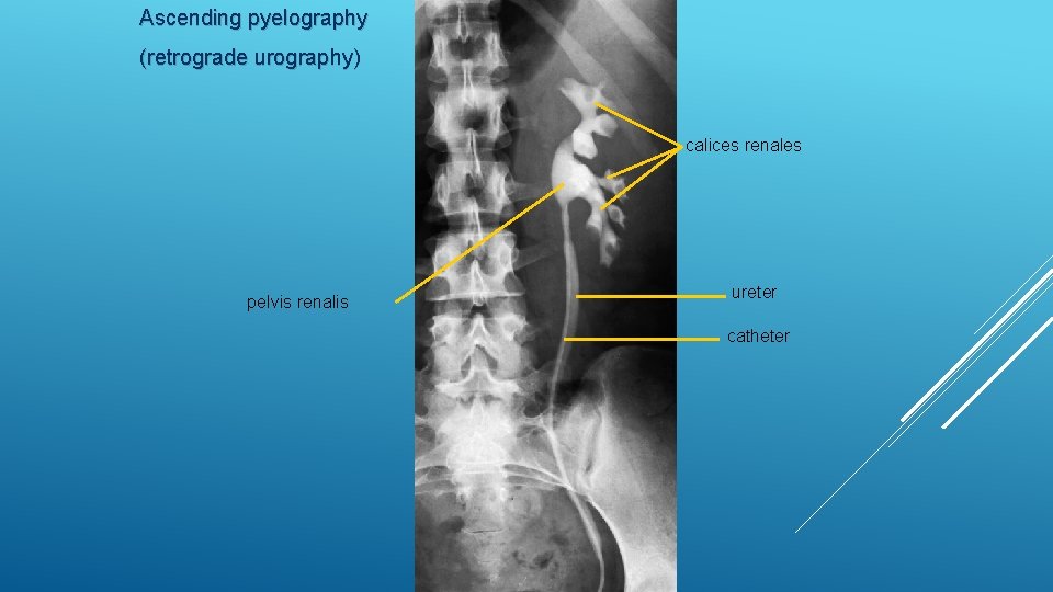 Ascending pyelography (retrograde urography) calices renales pelvis renalis ureter catheter 