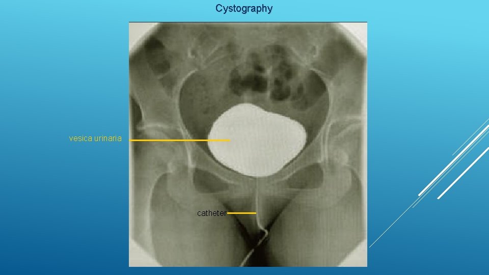 Cystography vesica urinaria catheter 