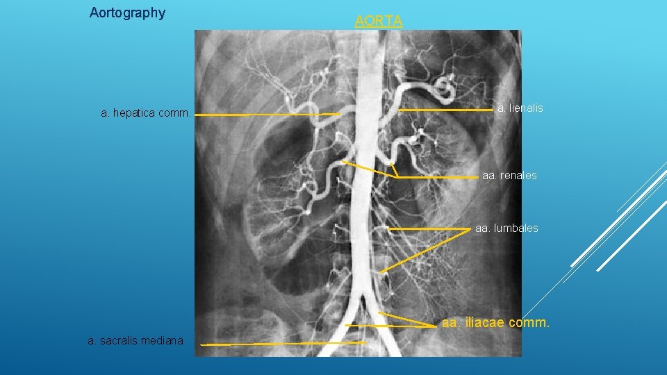 Aortography a. hepatica comm. AORTA a. lienalis aa. renales aa. lumbales aa. iliacae comm.