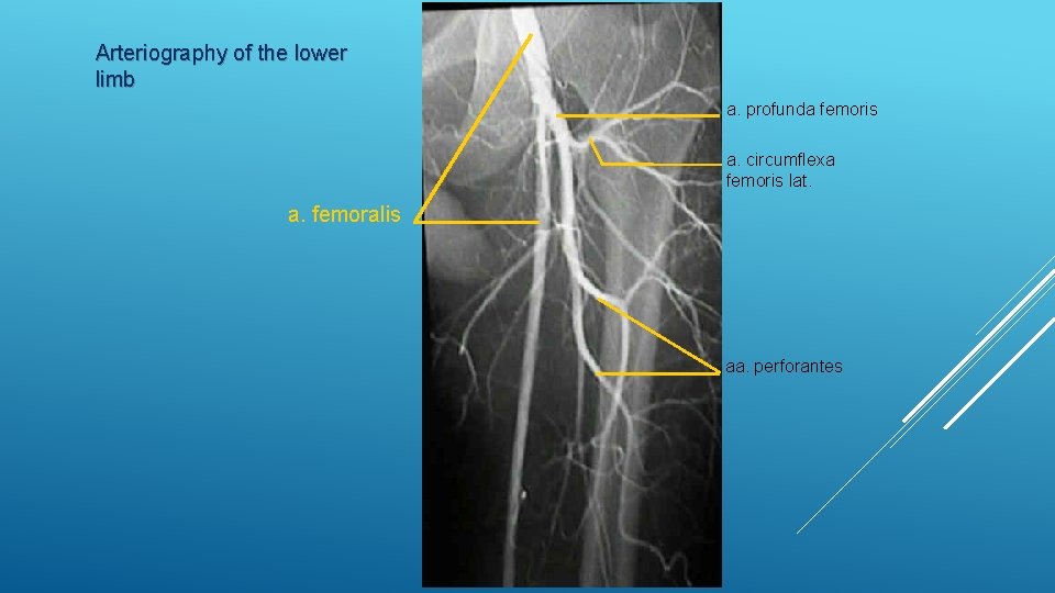 Arteriography of the lower limb a. profunda femoris a. circumflexa femoris lat. a. femoralis