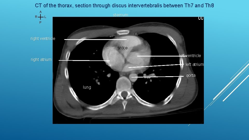 CT of the thorax, section through discus intervertebralis between Th 7 and Th 8