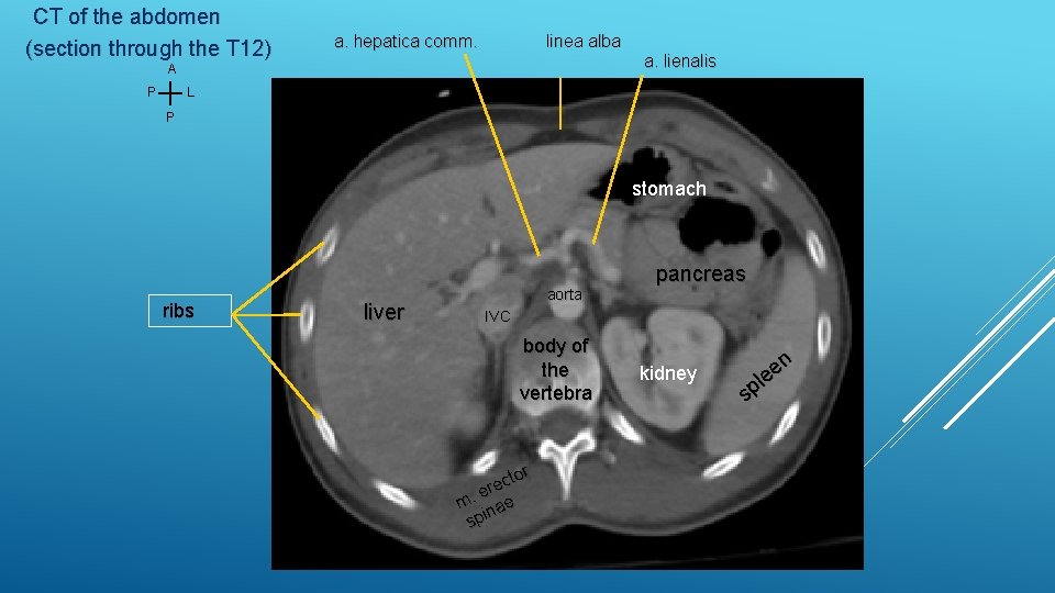 CT of the abdomen (section through the T 12) linea alba a. hepatica comm.