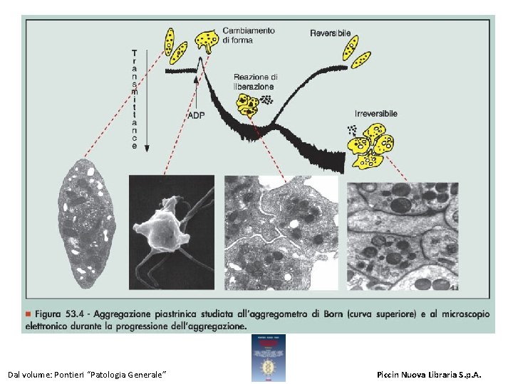 Figura 53. 4 - Aggregazione piastrinica studiata all'aggregometro di Born (curva superiore) e al