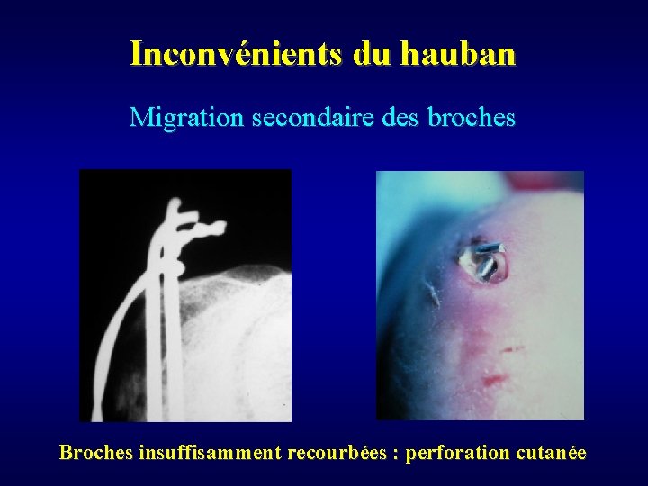 Inconvénients du hauban Migration secondaire des broches Broches insuffisamment recourbées : perforation cutanée 