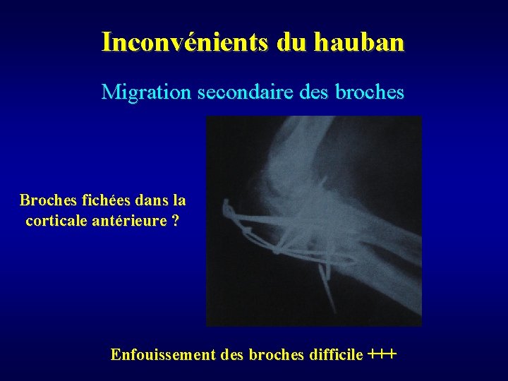 Inconvénients du hauban Migration secondaire des broches Broches fichées dans la corticale antérieure ?