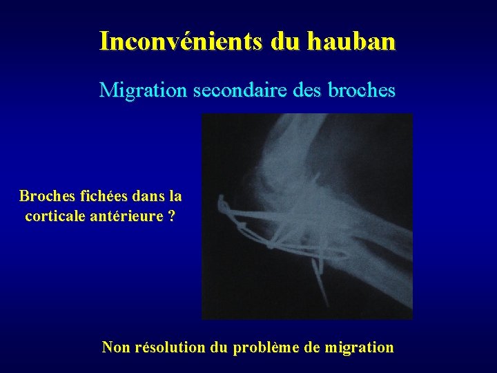 Inconvénients du hauban Migration secondaire des broches Broches fichées dans la corticale antérieure ?