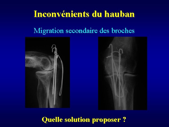 Inconvénients du hauban Migration secondaire des broches Quelle solution proposer ? 