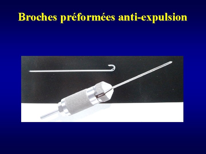 Broches préformées anti-expulsion 
