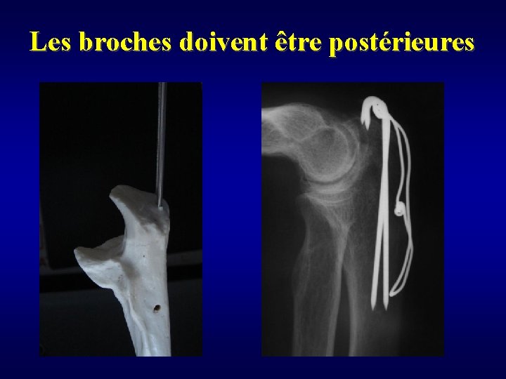 Les broches doivent être postérieures 