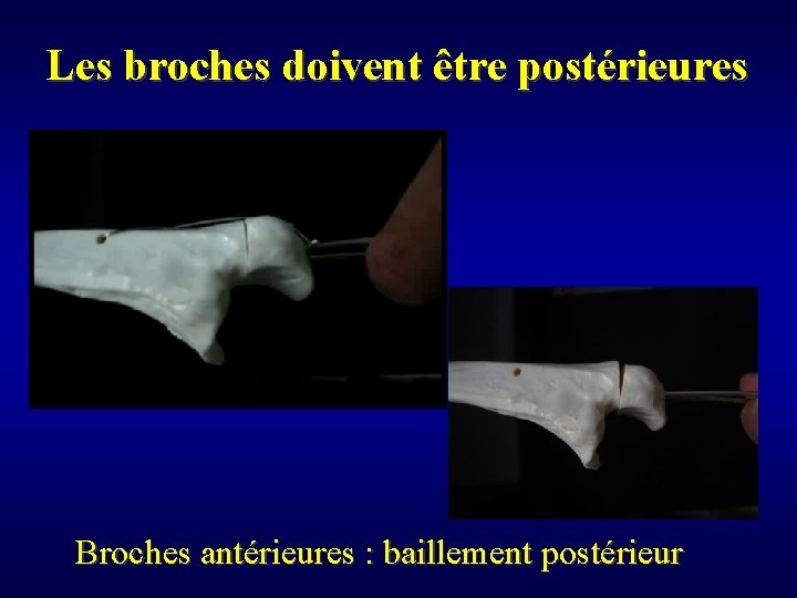 Les broches doivent être postérieures Broches antérieures : baillement postérieur 