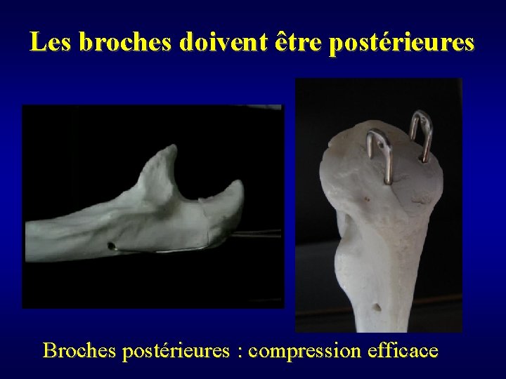 Les broches doivent être postérieures Broches postérieures : compression efficace 