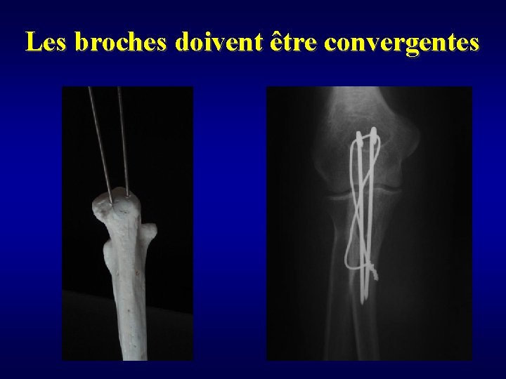 Les broches doivent être convergentes 