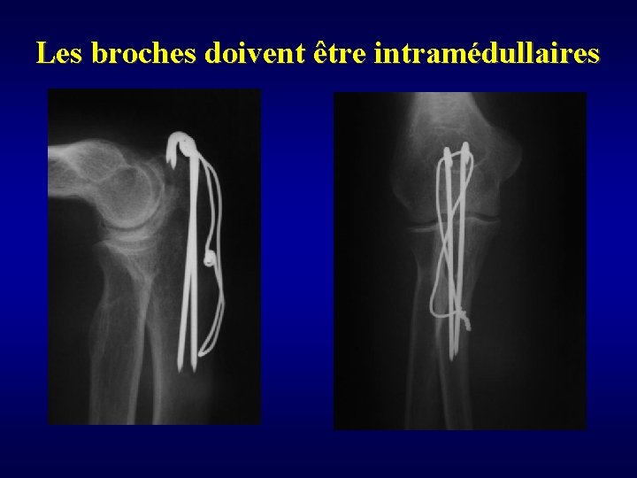 Les broches doivent être intramédullaires 
