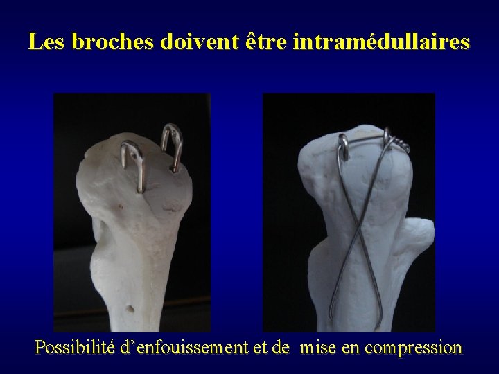 Les broches doivent être intramédullaires Possibilité d’enfouissement et de mise en compression 