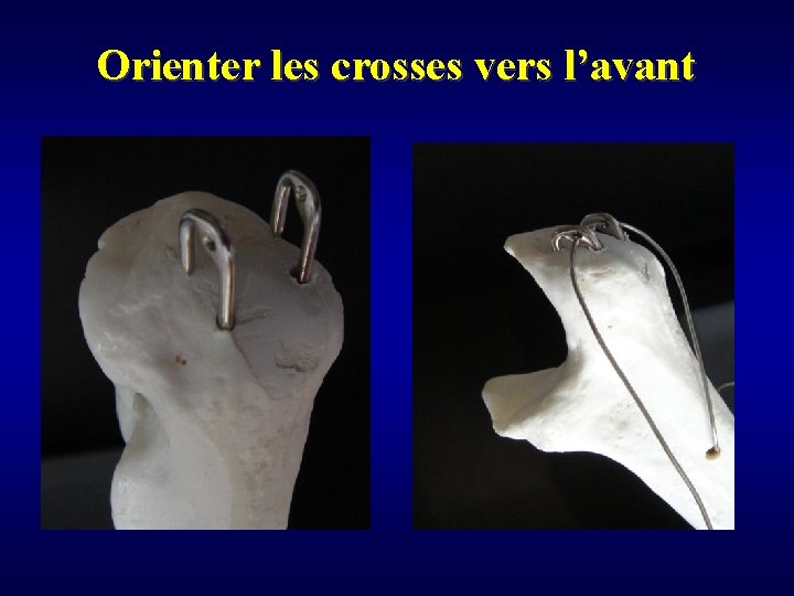 Orienter les crosses vers l’avant 