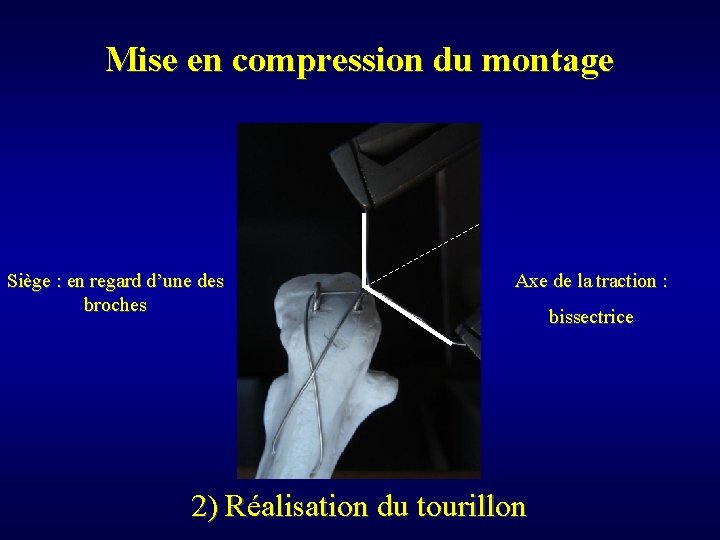 Mise en compression du montage Siège : en regard d’une des broches Axe de