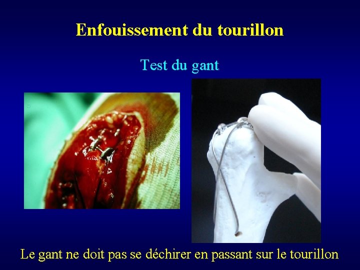 Enfouissement du tourillon Test du gant Le gant ne doit pas se déchirer en