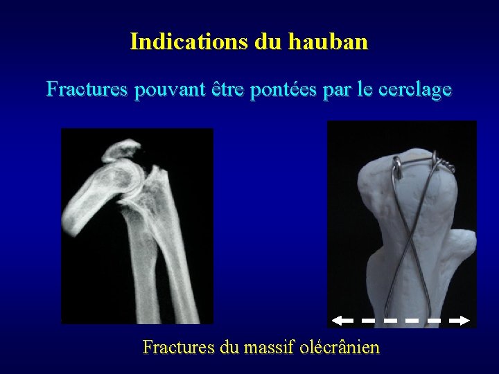 Indications du hauban Fractures pouvant être pontées par le cerclage Fractures du massif olécrânien