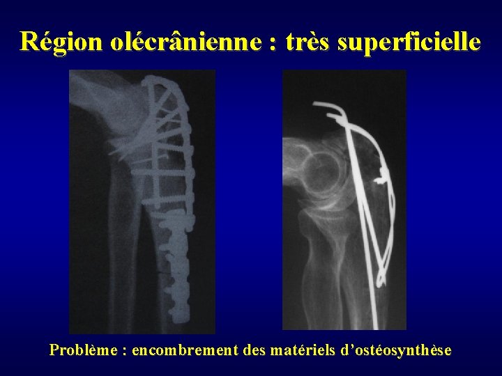 Région olécrânienne : très superficielle Problème : encombrement des matériels d’ostéosynthèse 