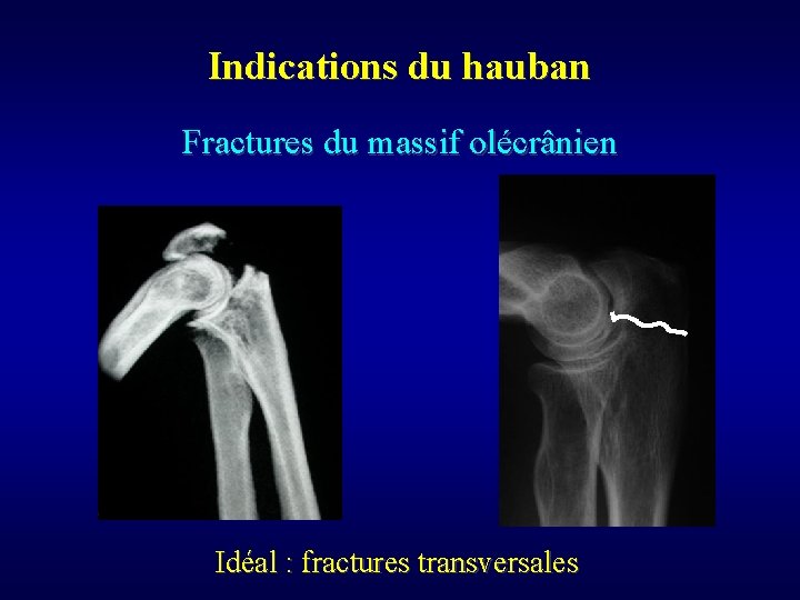 Indications du hauban Fractures du massif olécrânien Idéal : fractures transversales 