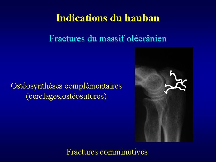 Indications du hauban Fractures du massif olécrânien Ostéosynthèses complémentaires (cerclages, ostéosutures) Fractures comminutives 