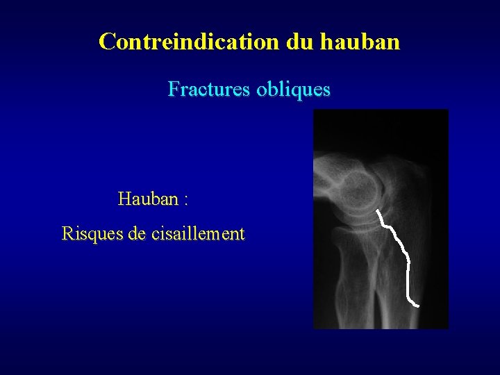 Contreindication du hauban Fractures obliques Hauban : Risques de cisaillement 