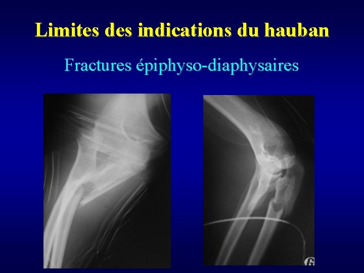Limites des indications du hauban Fractures épiphyso-diaphysaires 